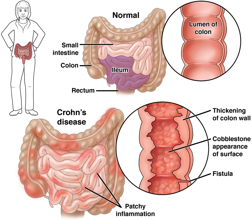 Crohns sjukdom